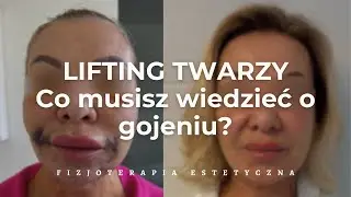 LIFTING TWARZY | Co musisz wiedzieć?