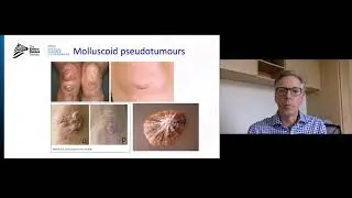 Manejo de Complicaciones en la Piel por el Dr. Nigel Burrows | Spanish (ES)