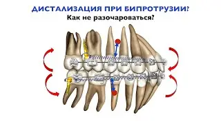 Дистализация при бипротрузии