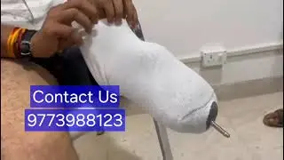 Below Knee Prosthesis with Silicon Gel Liner | +919773988123 | Artificial Leg with Gel Liner |