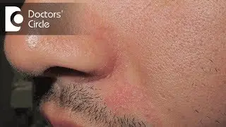 Is Lupus a hereditary disease Can you catch Lupus disease? - Dr. Yathish G. C