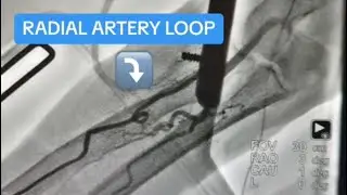 Navigating a Complex Radial Loop ( using a Terumo Glide catheter), Complex Lithotripsy & PCI LAD !