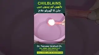 Chilblains: Home Remedy | گھریلو علاج | Dr. Tanveer Arshad Ch.
