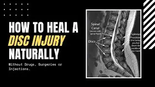 How to Heal A Disc Injury Without Surgery or Injections.