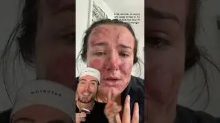 VIRAL ACNE ADVICE!😱 (follow for more!💗) #acne #acnetreatment #skincare #skin #skincareroutine