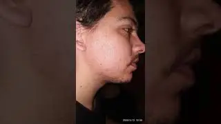Minoxidil beard jurney 2 months