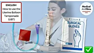 #tamponade UTERINE BALLOON TAMPONADE RETDEM