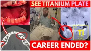 IT'S OVER: Jake Paul&rsquo;s MAJOR Surgery Done & Two Titanium Plates Inserted (Is It Career Ending?)