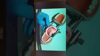 PVS Impression for Fixed Lab