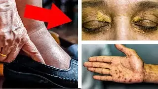 Ваше Сердце на грани. Если есть хоть один из этих 10 симптомов на коже.