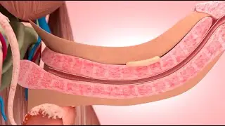 Peyronie Hastalığında ESWT (Extracorporeal Shock Wave Therapy in Peyronie's Disease)