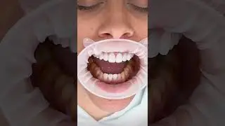 Unveil the Beauty of Your Smile with Zirconium Crowns and Laminate Veneers!