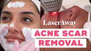 Clear + Brilliant Testimonial with Ome Khan - LaserAway