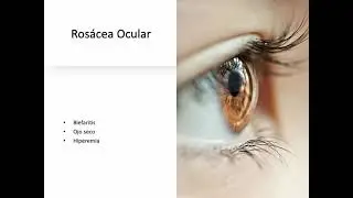 Ros&aacute;cea ocular, tipos su relaci&oacute;n con el ojo y demod&eacute;x