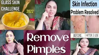 Acne treatment at home|Remove pimples overnight|roshnivlog