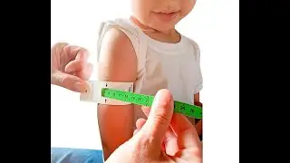 Uses of Shakir strip or tape in pediatrics or MUAC Mid Upper Arm Circumference tape