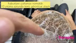 Sa&ccedil; ekimi sonrası 7. G&uuml;n ve ilk yıkama sonrası 4. G&uuml;n. k&ouml;k alınan ve ekim b&ouml;lgesinin g&ouml;r&uuml;nt&uuml;leri.