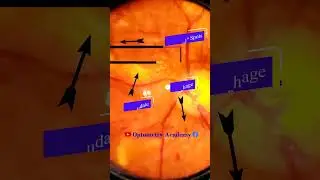 Diabetic retinopathy | Hemorrhages | cotton wool spots | Hard exudates | Fundus | Short Video 126