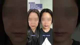 Facelift, double chin lifting, and double chin liposuction #facelift #kbeuty #drkwakminho #dasipium