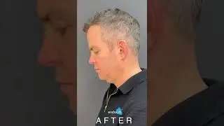 Say Goodbye to Your Double Chin: Male Endolift Procedure by Dr Nina Bal