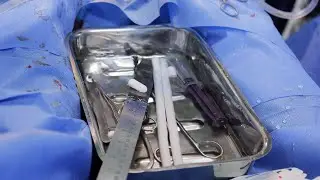Safe & Effective ED Surgery | Rigi 10 Implant and ZSR Stapler Circumcision | Tamil