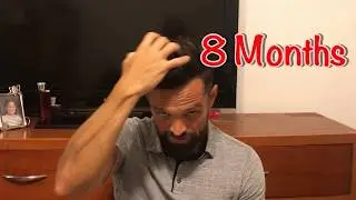 8 MONTHS | 2nd Procedure | Hair Medical Restoration | Tijuana | 8 Months Minoxidil Use