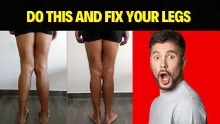 How To Correct The VALGUS Knee | HAND Knee at HOME | Bow Legs No More