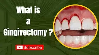 What is a Gingivectomy ?/ Gingivectomy