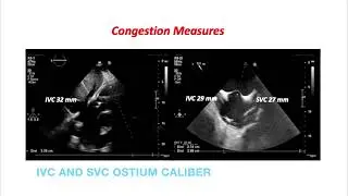 Net clinical and anatomical benefit after 3 Months of TricValve implant with Impella RP Support.