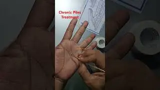 Single point treatment for Chronic Piles #piles #acupressureforpiles #acupressure