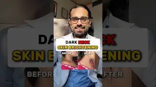 Dark Neck Skin Brightening 🥰 #darkneck #skinbrightening