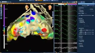 Cardioaritmie_ripristino ritmo sinusale in RF