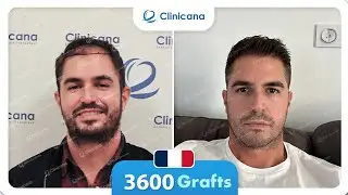 R&eacute;sultat de greffe de cheveux Clinicana en Turquie micro fue sapphire
