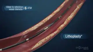 Shockwave Lithoplasty System