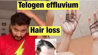 Telogen Effluvium Hair Loss After Traumatic Event |अचानक से बालो का गिराना | Covid के बाद बाल झड़ना