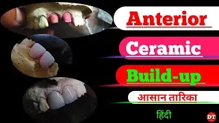 Anterior build up Technique| Ceramic Build up| anatomy| human tooth| laboratory| dental videos| lab