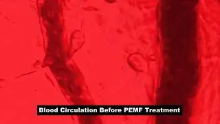 Blood Flow Before & After a PEMF Health Inc. Treatment