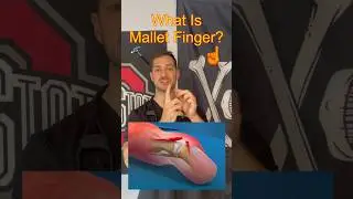 What Is Mallet Finger? What is It From? Do You Have It? #shorts #hand #medical
