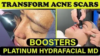 Acne Scars & Glow Micro needling | Platinum HydraFacial MD with Boosters | Beloria Academy