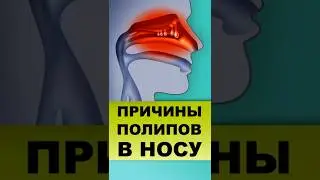 ПОЛИПЫ НОСА, причины, тактика лечения #полипыноса #полипы #ринит