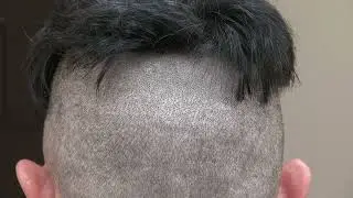 FUE MINIMAL SCAR: SF BAY AREA BY MEDICAL HAIR TRANSPLANT & AESTHETICS
