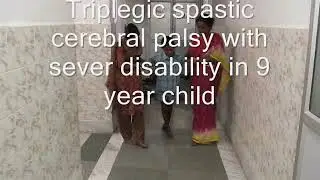 Cerebral Palsy :  SEMLS with the OSSCS concept.wmv