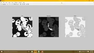 Detection of parasites from images of red blood cells using HSV segmentation