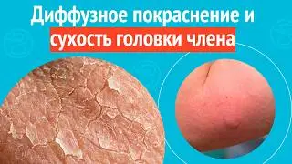 😡 Diffuse redness and dryness of the glans penis. Case report #1744