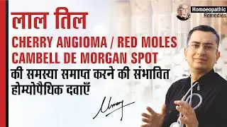 लाल तिल || Cherry Angioma / Red Moles / Cambell de Morgan Spot || Natural homeopathic remedies