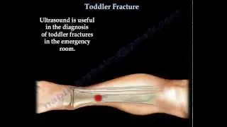 Toddler Fracture , tibial fracture in a child- Everything You Need To Know - Dr. Nabil Ebraheim