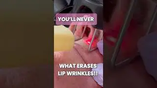 This Laser just erased lip wrinkles in seconds !!! 😱😱