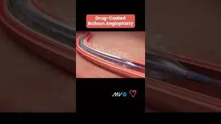 💊🎈 Ангиопластика с использованием баллона с лекарственным покрытием