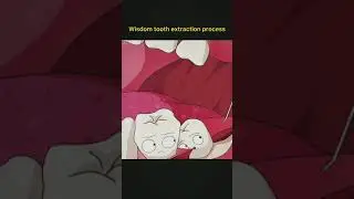 Wisdom teeth extraction