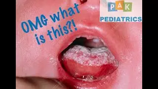 Tongue infection?! Newborn Oral thrush and treatment | Let&rsquo;s Talk About!